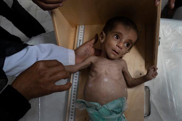 Yemen: 85 mila bambini morti di fame e stenti a causa di guerra saudita